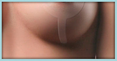 Gel de silicona Epi-Derm para areopexia